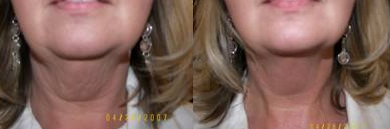 Neck Cellulite