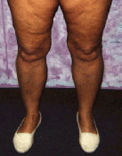 before cellulite legs