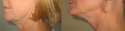 neck  cellulite