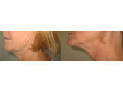 I Shrunk My Stomach Without Liposuction Read My Story Here