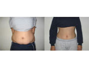 I Shrunk My Stomach Without Liposuction Read My Story Here
