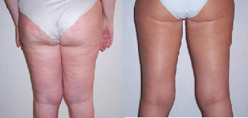 liposuction on legs