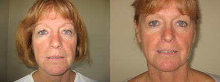 mesotherapy alternative 