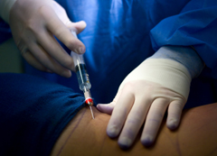 mesotherapy injection 