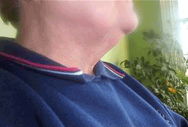 neck after lift