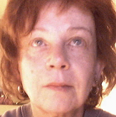 neck lift