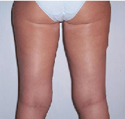 after fat reduction