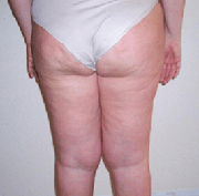 before fat