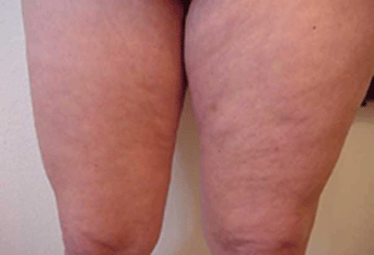 leg fat reduced