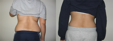 back fat reduced