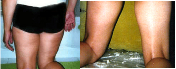 thigh fat reduced