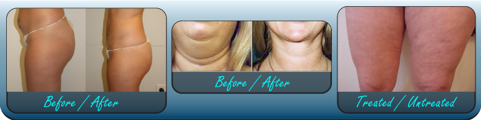 beatsliposuction.com